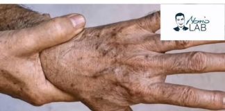 PERŠIN Zauvijek Uklanja STARAČKE MRLJE! Ovo Morate Napraviti…