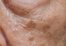 Prvi simptom MASNE JETRE vidi se na LICU obolelog – Znojenje i loš dah se najlakše prepoznaju, ali ove SIGNALE tela mnogi