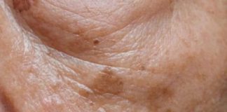 Prvi simptom MASNE JETRE vidi se na LICU obolelog – Znojenje i loš dah se najlakše prepoznaju, ali ove SIGNALE tela mnogi