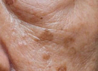 Prvi simptom MASNE JETRE vidi se na LICU obolelog – Znojenje i loš dah se najlakše prepoznaju, ali ove SIGNALE tela mnogi