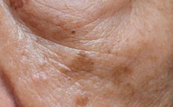 Prvi simptom MASNE JETRE vidi se na LICU obolelog – Znojenje i loš dah se najlakše prepoznaju, ali ove SIGNALE tela mnogi