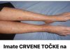 Imate CRVENE TOČKE na nogama? Žene trebaju obratiti pozornost jerse to lako može spriječiti…