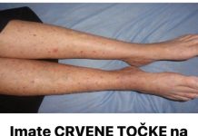 Imate CRVENE TOČKE na nogama? Žene trebaju obratiti pozornost jerse to lako može spriječiti…