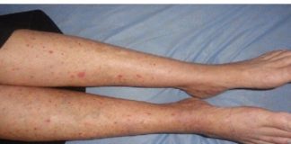 Imate CRVENE TOČKE na nogama? Žene trebaju obratiti pozornost jerse to lako može spriječiti…