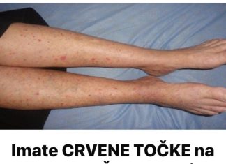 Imate CRVENE TOČKE na nogama? Žene trebaju obratiti pozornost jerse to lako može spriječiti…