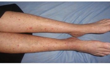 Imate CRVENE TOČKE na nogama? Žene trebaju obratiti pozornost jerse to lako može spriječiti…