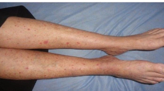 Imate CRVENE TOČKE na nogama? Žene trebaju obratiti pozornost jerse to lako može spriječiti…