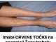 Imate CRVENE TOČKE na nogama? Žene trebaju obratiti pozornost jerse to lako može spriječiti…