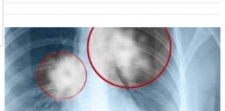 Ubica Šlajma I Tjeskobe U Grudima: Smjesa Od TRI Sastojka Liječi Vaša PLUĆA I Disajne Puteve