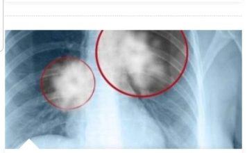 Ubica Šlajma I Tjeskobe U Grudima: Smjesa Od TRI Sastojka Liječi Vaša PLUĆA I Disajne Puteve