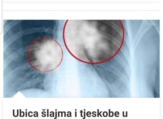 Ubica Šlajma I Tjeskobe U Grudima: Smjesa Od TRI Sastojka Liječi Vaša PLUĆA I Disajne Puteve