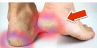 Ispucale pete zauvijek nestaju uz OVE kućne lijekove💥(Super lako)🤯