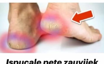 Ispucale pete zauvijek nestaju uz OVE kućne lijekove💥(Super lako)🤯