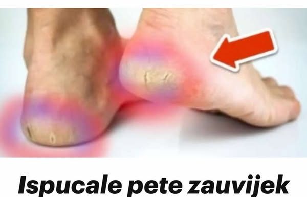 Ispucale pete zauvijek nestaju uz OVE kućne lijekove💥(Super lako)🤯