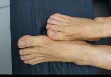 Povišene razine holesterola možete prepoznati promatranjem stanja vaših nogu …