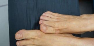 Povišene razine holesterola možete prepoznati promatranjem stanja vaših nogu …