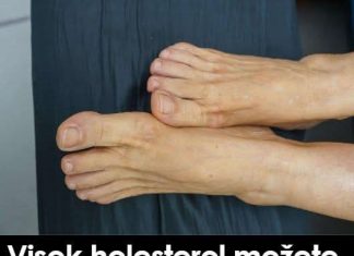 Povišene razine holesterola možete prepoznati promatranjem stanja vaših nogu …