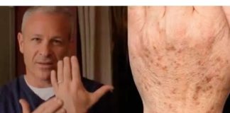 Sok od luka + jabukovo sirće: Samo pomiješajte i riješite se staračkih pjega na rukama, licu i dekolteu jednom za svagda!