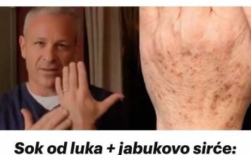 Sok od luka + jabukovo sirće: Samo pomiješajte i riješite se staračkih pjega na rukama, licu i dekolteu jednom za svagda!