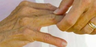 Ova hrana je štetna za zdravlje kostiju; Konzumacija može pogoršati bol, ubrzati napredovanje artritisa i dovesti do daljnjeg propadanja zglobova.