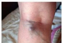 NAMIRNICE KOJE POVEĆAVAJU RIZIK OD TROMBOZE, JEDNA POSEBNO:Jedemo ih svakoga dana, a štete arterijama