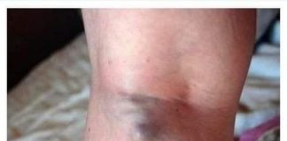 NAMIRNICE KOJE POVEĆAVAJU RIZIK OD TROMBOZE, JEDNA POSEBNO:Jedemo ih svakoga dana, a štete arterijama