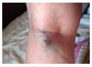 NAMIRNICE KOJE POVEĆAVAJU RIZIK OD TROMBOZE, JEDNA POSEBNO:Jedemo ih svakoga dana, a štete arterijama