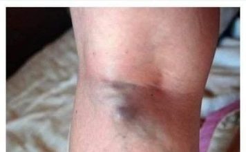 NAMIRNICE KOJE POVEĆAVAJU RIZIK OD TROMBOZE, JEDNA POSEBNO:Jedemo ih svakoga dana, a štete arterijama