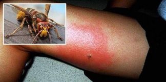 UJEO VAS JE STRŠLJEN? EVO ŠTA ODMAH URADITI! 🐝