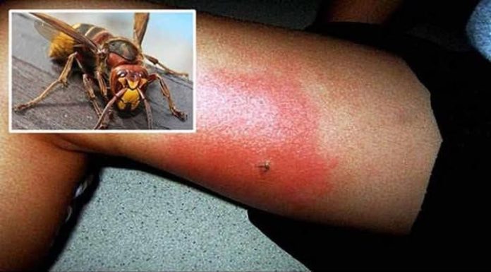 UJEO VAS JE STRŠLJEN? EVO ŠTA ODMAH URADITI! 🐝