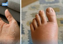 10 ZNAKOVA koje tijelo šalje i upozorava DA NIVO ŠEĆERA U VAŠEM TIJELU NIJE NORMALAN