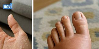 10 ZNAKOVA koje tijelo šalje i upozorava DA NIVO ŠEĆERA U VAŠEM TIJELU NIJE NORMALAN