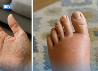 10 ZNAKOVA koje tijelo šalje i upozorava DA NIVO ŠEĆERA U VAŠEM TIJELU NIJE NORMALAN