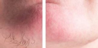 DLAČICE S LICA nestaju kao rukom odnesene Sve žene širom svijeta potpuno su poludile za ovim receptom!