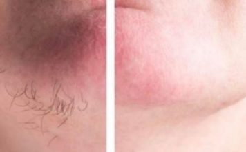 DLAČICE S LICA nestaju kao rukom odnesene Sve žene širom svijeta potpuno su poludile za ovim receptom!