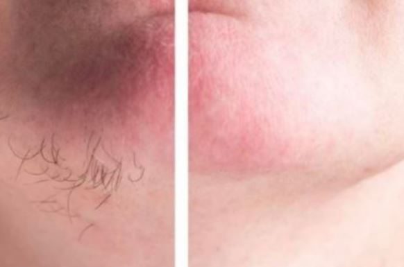 DLAČICE S LICA nestaju kao rukom odnesene Sve žene širom svijeta potpuno su poludile za ovim receptom!