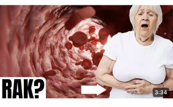 Prvi znakovi raka debelog crijeva koje žene ignoriraju!