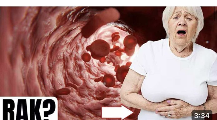 Prvi znakovi raka debelog crijeva koje žene ignoriraju!