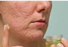 Evo kako da napravite domaću kremu za uklanjanje ožiljaka i podmlađivanje kože lic