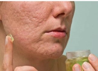 Evo kako da napravite domaću kremu za uklanjanje ožiljaka i podmlađivanje kože lic