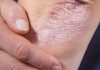 NE BACAJTE NI SLUČAJNO KORU OD OVE VOĆKE: Liječi Psorijazu, Skida Bradavice I Izbjeljuje Zube!