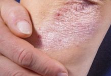 NE BACAJTE NI SLUČAJNO KORU OD OVE VOĆKE: Liječi Psorijazu, Skida Bradavice I Izbjeljuje Zube!