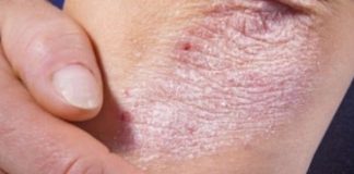 NE BACAJTE NI SLUČAJNO KORU OD OVE VOĆKE: Liječi Psorijazu, Skida Bradavice I Izbjeljuje Zube!