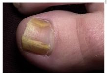 RIJEŠITE SE ŽUTIH I ZADEBLJALIH N0KTIJU UZ 0VAJ PREPARAT POGLEDAJTE SVE NA LINKU U KOMENTARU ⬇️⬇️⬇️