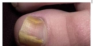 RIJEŠITE SE ŽUTIH I ZADEBLJALIH N0KTIJU UZ 0VAJ PREPARAT POGLEDAJTE SVE NA LINKU U KOMENTARU ⬇️⬇️⬇️