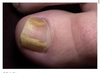 RIJEŠITE SE ŽUTIH I ZADEBLJALIH N0KTIJU UZ 0VAJ PREPARAT POGLEDAJTE SVE NA LINKU U KOMENTARU ⬇️⬇️⬇️