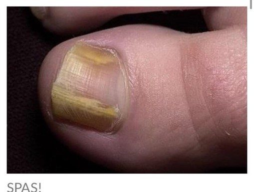 RIJEŠITE SE ŽUTIH I ZADEBLJALIH N0KTIJU UZ 0VAJ PREPARAT POGLEDAJTE SVE NA LINKU U KOMENTARU ⬇️⬇️⬇️