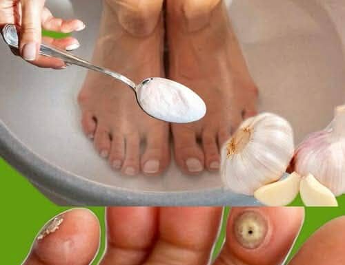 Imate li kurje oči ili znate nekoga tko ima? Evo kako ih se riješiti preko noći uz ovu moćnu mješavinu