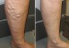 ČUDOTVORNI MELEM: Pomiješajte ova tri sastojka i proširene vene će nestati preko noći ČUDOTVORNI MELEM: Pomiješajte ova tri sastojka i proširene vene će nestati preko noći - featured image
