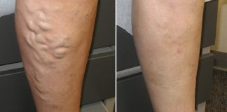 ČUDOTVORNI MELEM: Pomiješajte ova tri sastojka i proširene vene će nestati preko noći ČUDOTVORNI MELEM: Pomiješajte ova tri sastojka i proširene vene će nestati preko noći - featured image